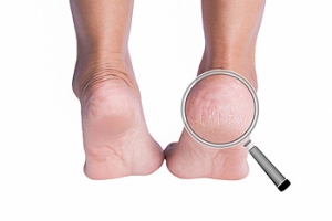 Ugly Cracked Heels
